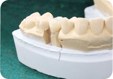 CAD/CAM ハイブリッドセラミック（保険適用）