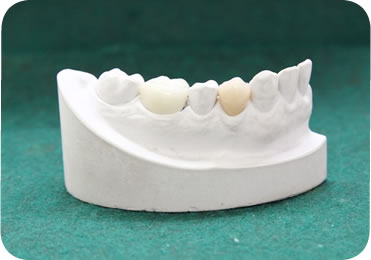 セラミック（保険外治療）