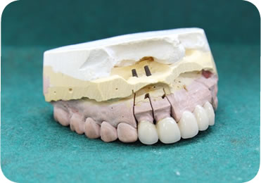 メタルボンド（保険外治療）