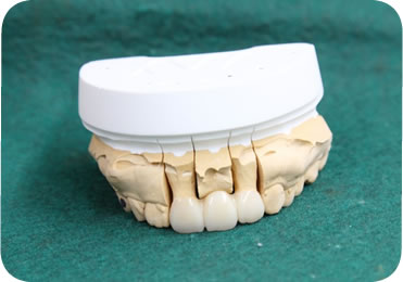 ジルコニア（保険外治療）