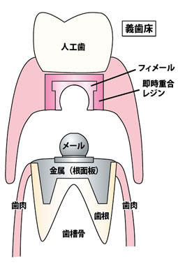クーゲルホック(ホック式の入れ歯用アタッチメント)